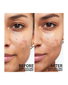 THE INKEY LIST Succinic Acid Blemish Treatment